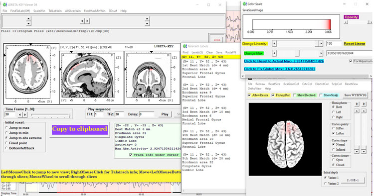 Figure 14 - Baseline eyes-open z-score LORETA analysis for 30 Hz